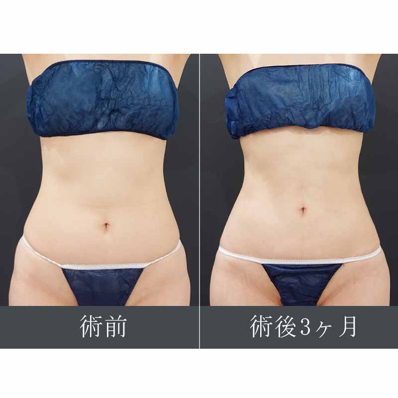 【上下白有】20240213_F2294_kaneko_stomach-liposuction_O_part P縦