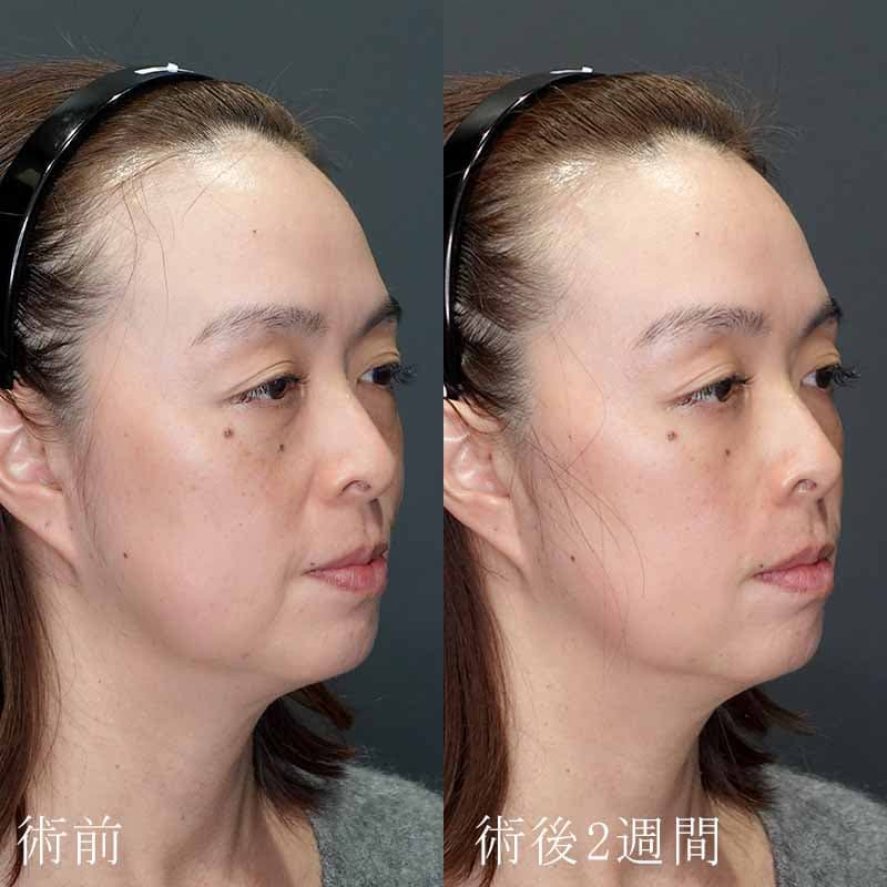 20240306_G37224_tukahara_hyaluronic acid lift01