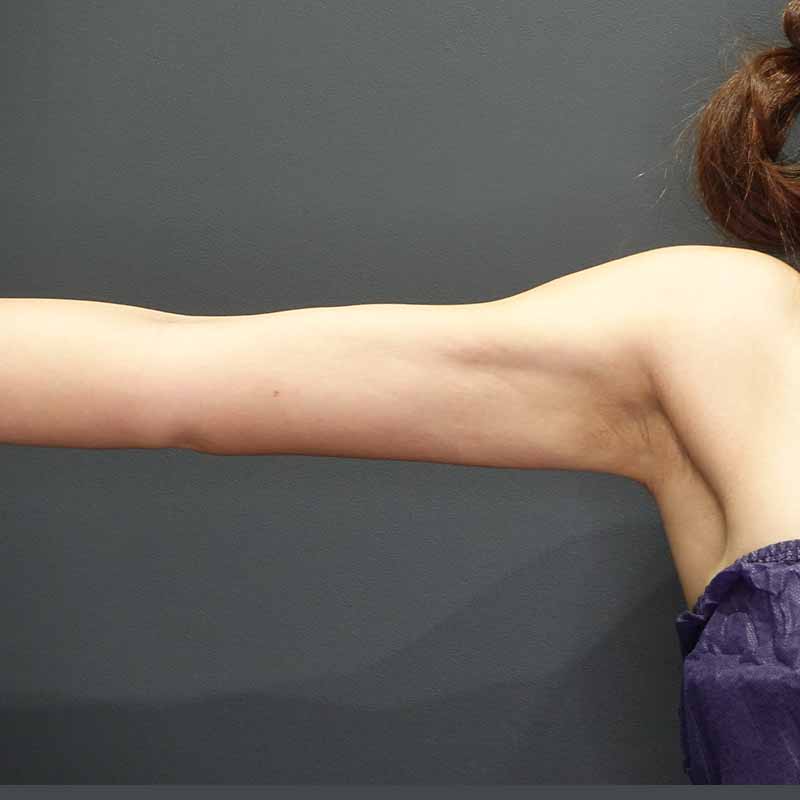 20240307_G28545_ishihara_arm-liposuction追加写真②After