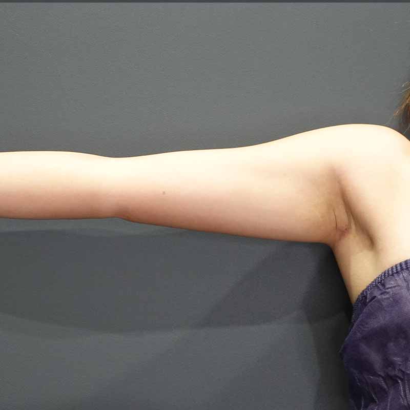20240307_G28545_ishihara_arm-liposuction追加写真②Before