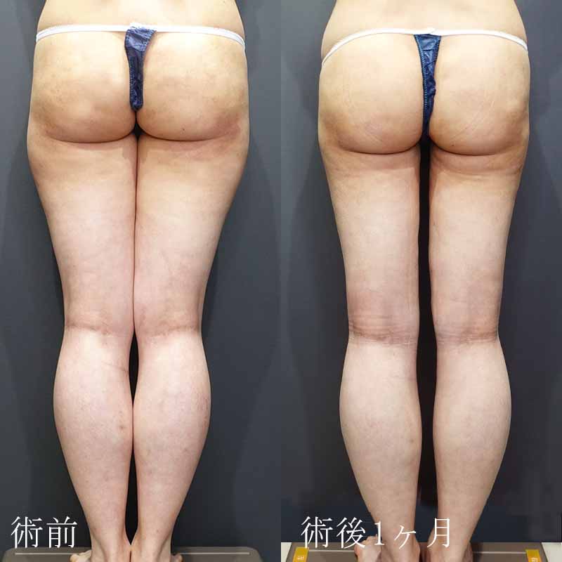 20240308_G27368_takemura_thigh-liposuction