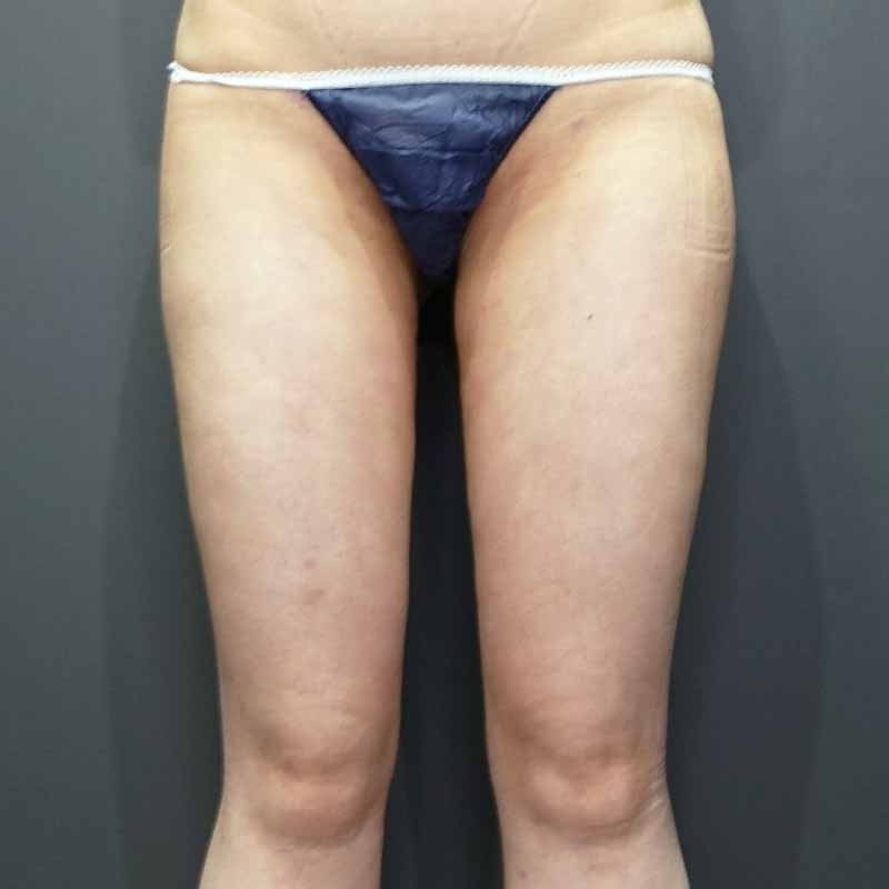 20240308_G27368_takemura_thigh-liposuction①After