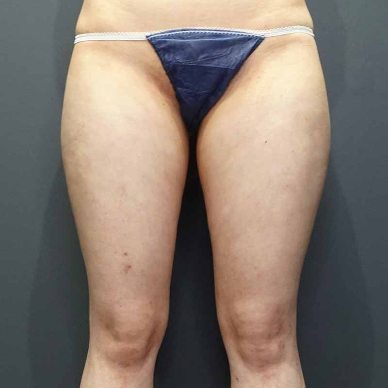 20240308_G27368_takemura_thigh-liposuction①Before