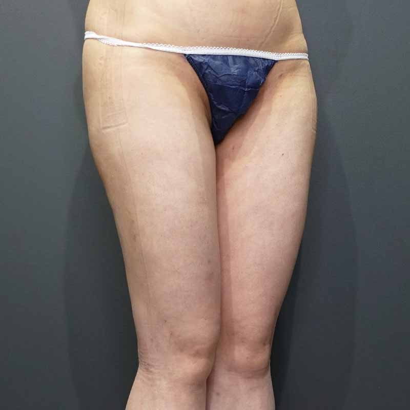 20240308_G27368_takemura_thigh-liposuction②After