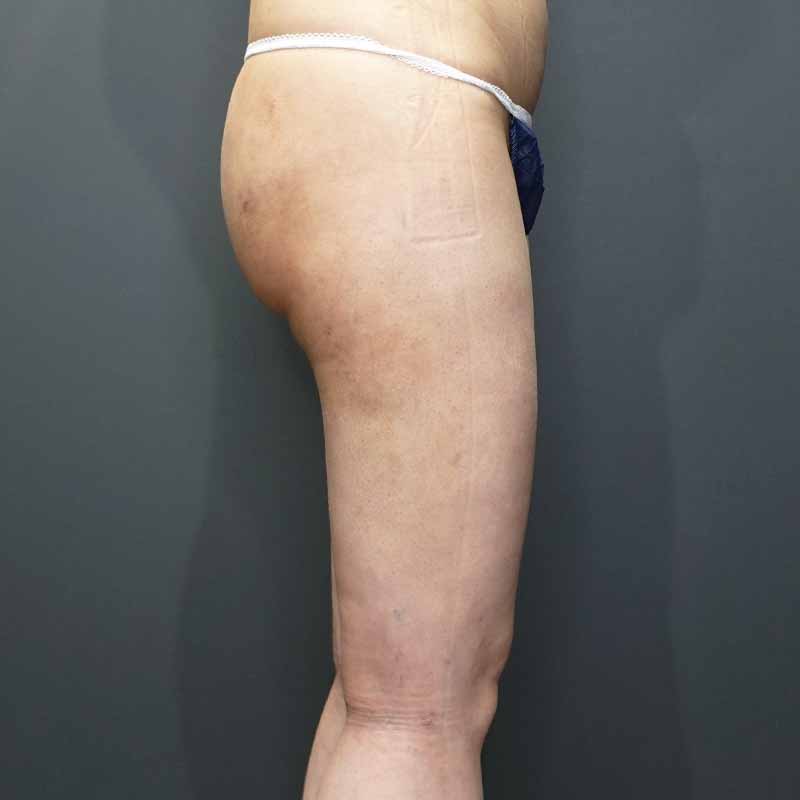 20240308_G27368_takemura_thigh-liposuction③After
