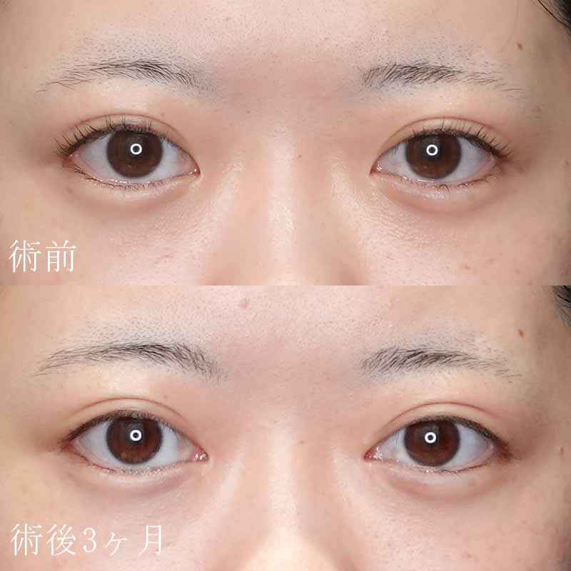 20240314_S17128_tukahara_epicanthoplasty01