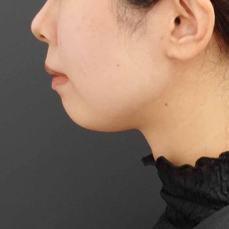 20240322_F891_kaneko_hyaluronic jaw追加写真①Before