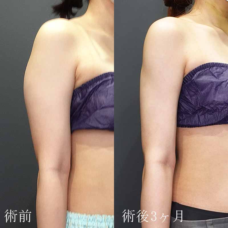 20240323_G29626_ishihara_arm-liposuction 縦