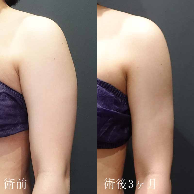 20240323_G30634_ishihara_arm-liposuction 縦