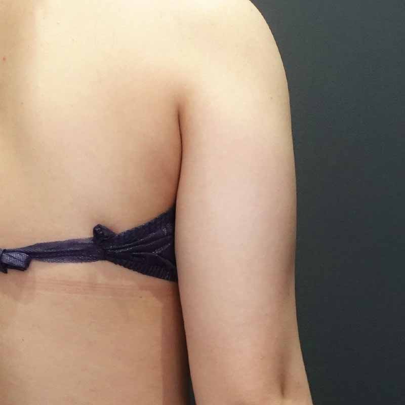 20240323_G30634_ishihara_arm-liposuction追加写真①Before