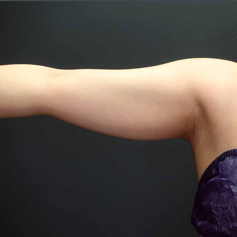 20240323_G30634_ishihara_arm-liposuction追加写真②Before