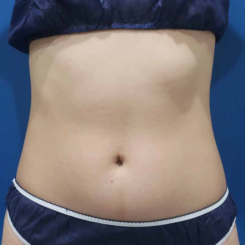 20240329_S15208_suzuki_stomach-liposuction追加写真①Before