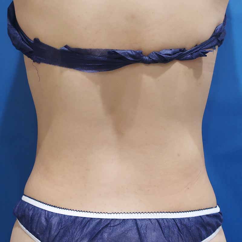 20240329_S15208_suzuki_stomach-liposuction追加写真②After