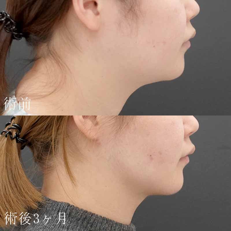20240330_F-3444_hurumura_face-liposuction_philtrum-botox01