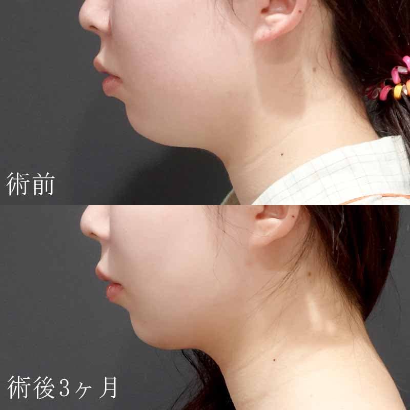 20240330_S19791_hurumura_face-liposuction_philtrum-botox01