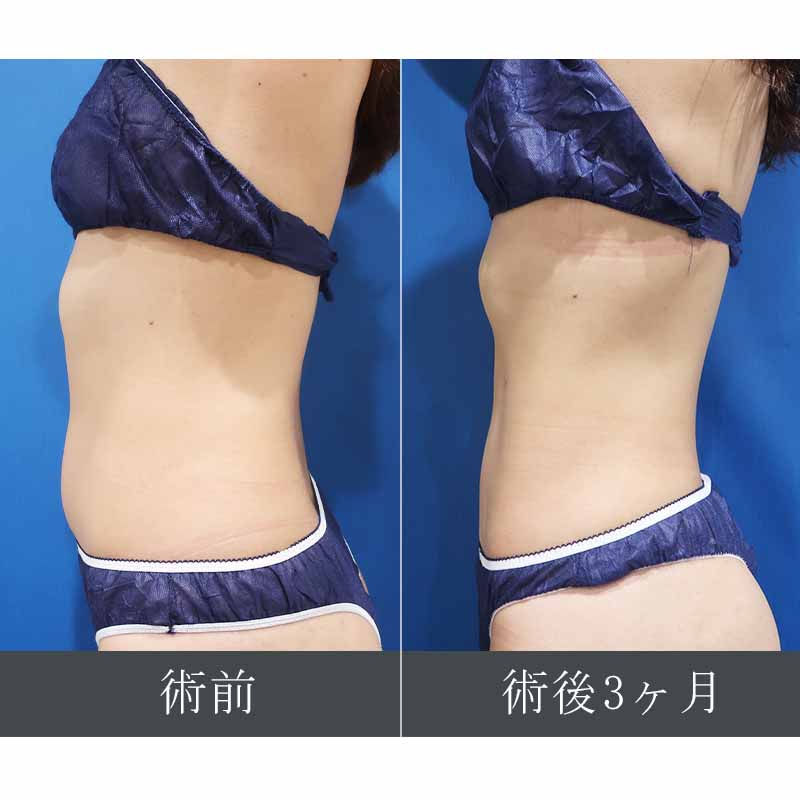 【上下白有】20240329_S15208_suzuki_stomach-liposuction縦