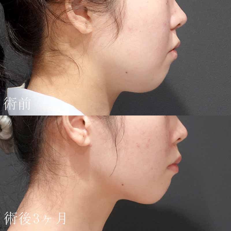 20240403_S24855_hurumura_face-liposuction_philtrum-botox01