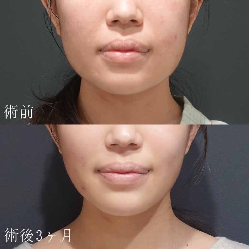 20240404_S25519_hurumura_face-liposuction_philtrum-botox01