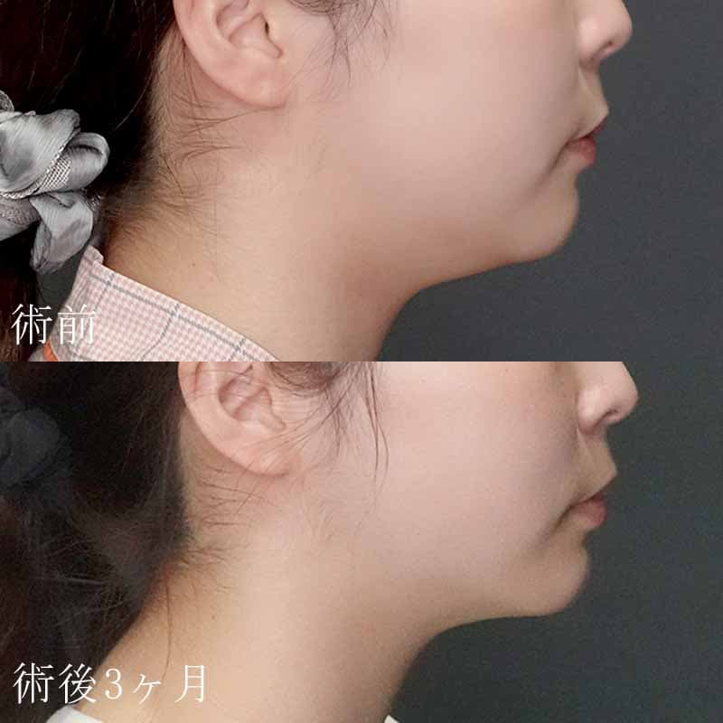 20240407_S20240407_tukahara_face-liposuction01