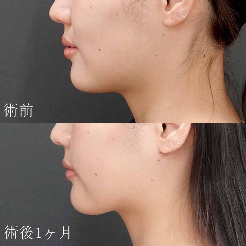 20240408_S20240408_tukahara_face-liposuction01