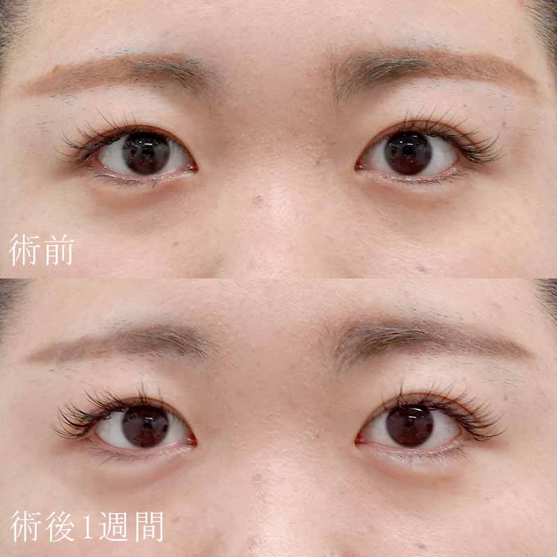 20240411_G29424_tukahara_hyaluronic eye bags01