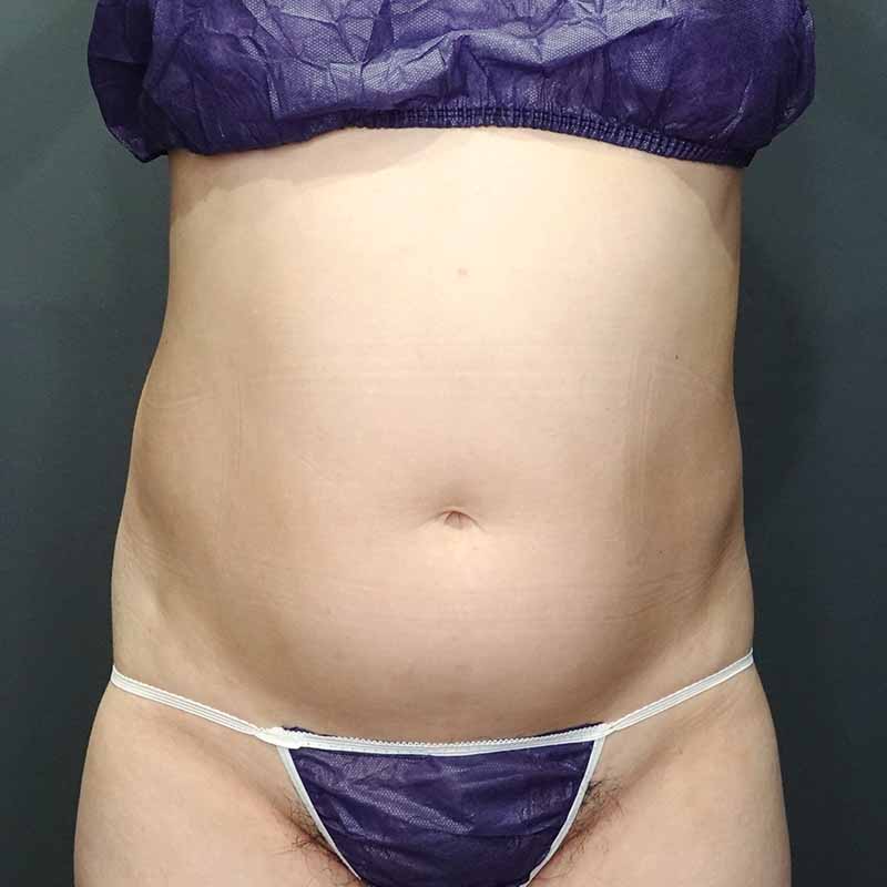 20240419_G32353_takemura_stomach-liposuction追加写真①Before