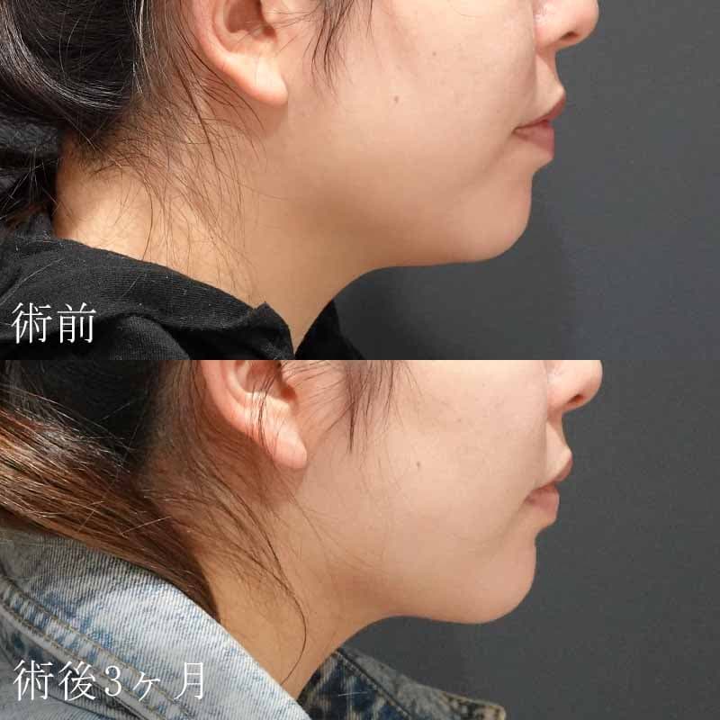 20240419_S20240419_tukahara_face-liposuction01