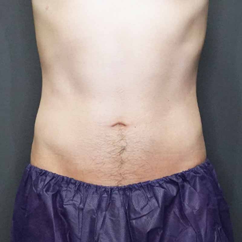 20240420_G36535_takemura_stomach-liposuction追加写真①After
