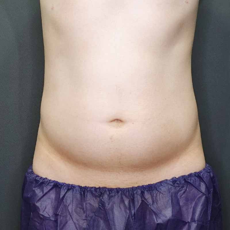 20240420_G36535_takemura_stomach-liposuction追加写真①Before