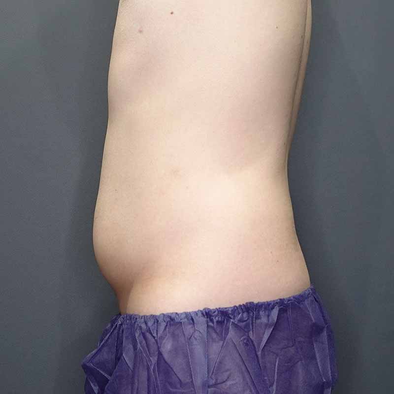 20240420_G36535_takemura_stomach-liposuction追加写真②Before