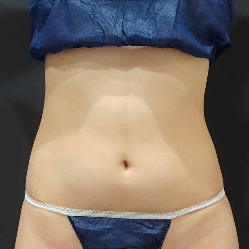 20240421_S22972_suzuki_stomach-liposuction追加写真①Before