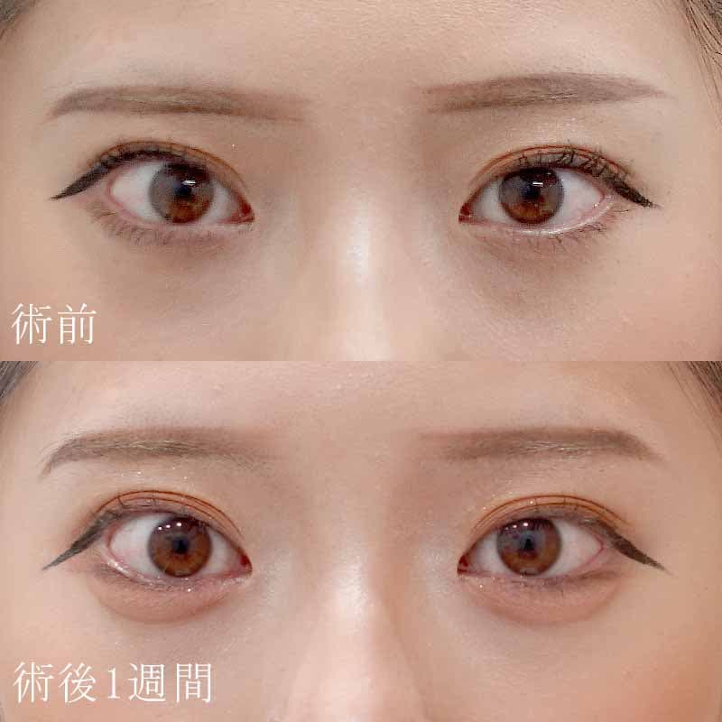 20240427_G36835_nakamura_hyaluronic eye bags01