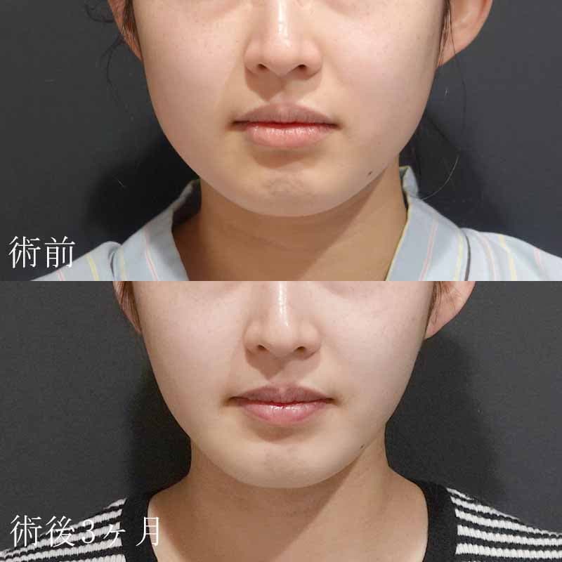 20240428_G36617_hurumura_face-liposuction01