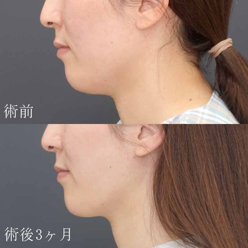 20240429_N46083_hurumura_face-liposuction01