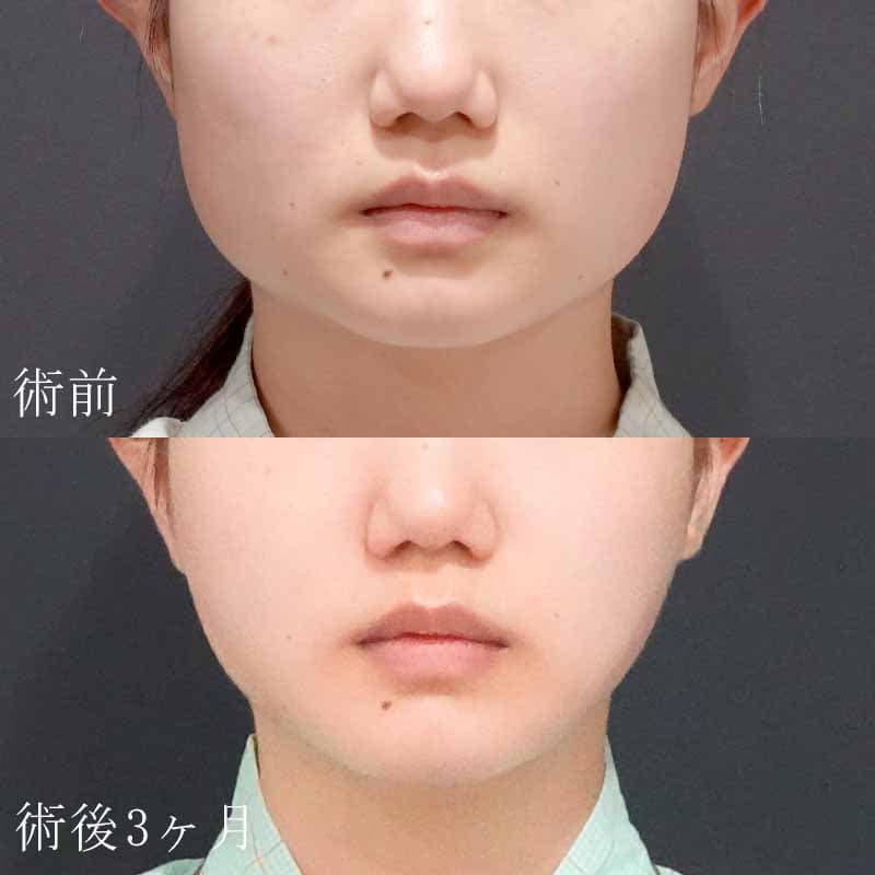 20240430_O5934_hurumura_face-liposuction01