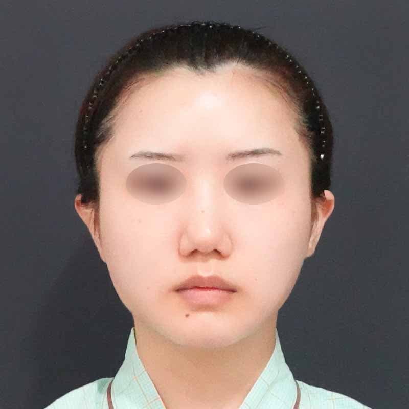 20240430_O5934_hurumura_face-liposuction02①After