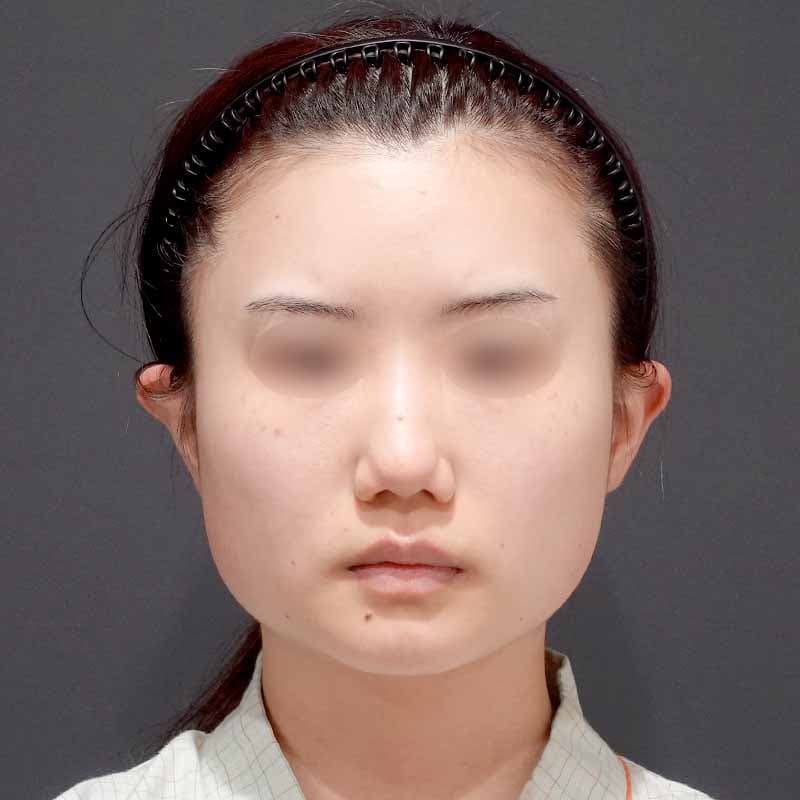 20240430_O5934_hurumura_face-liposuction02①Before