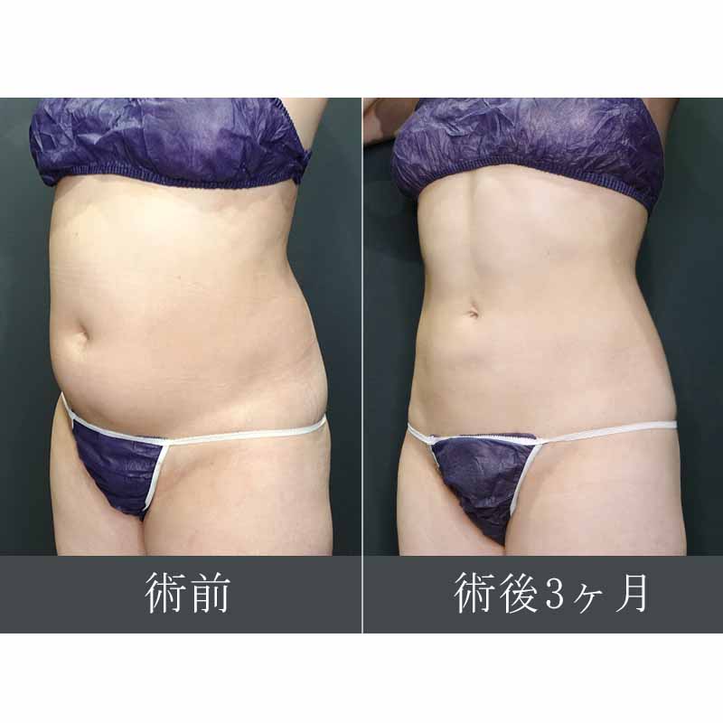 【上下白有】20240419_G32353_takemura_stomach-liposuction縦
