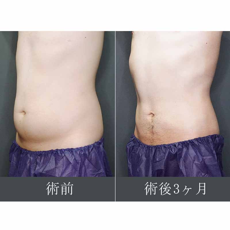 【上下白有】20240420_G36535_takemura_stomach-liposuction縦