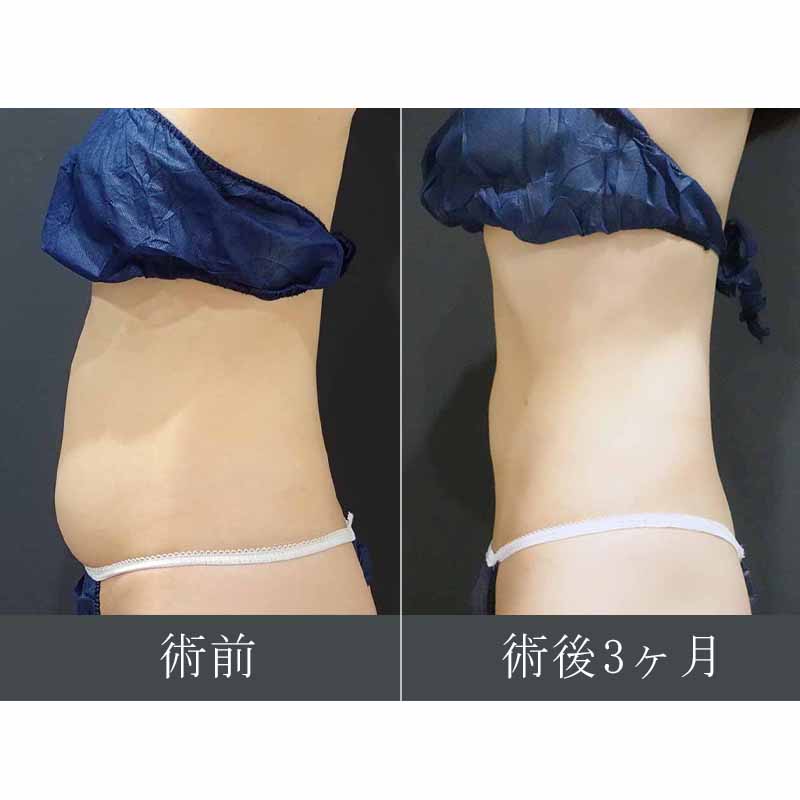 【上下白有】20240421_S22972_suzuki_stomach-liposuction縦