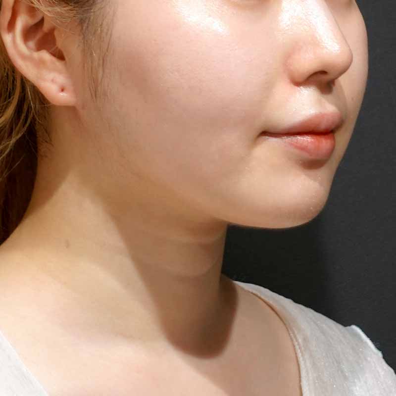 20240509_G27976_suzuki_face-liposuction_philtrum-botox追加写真①After
