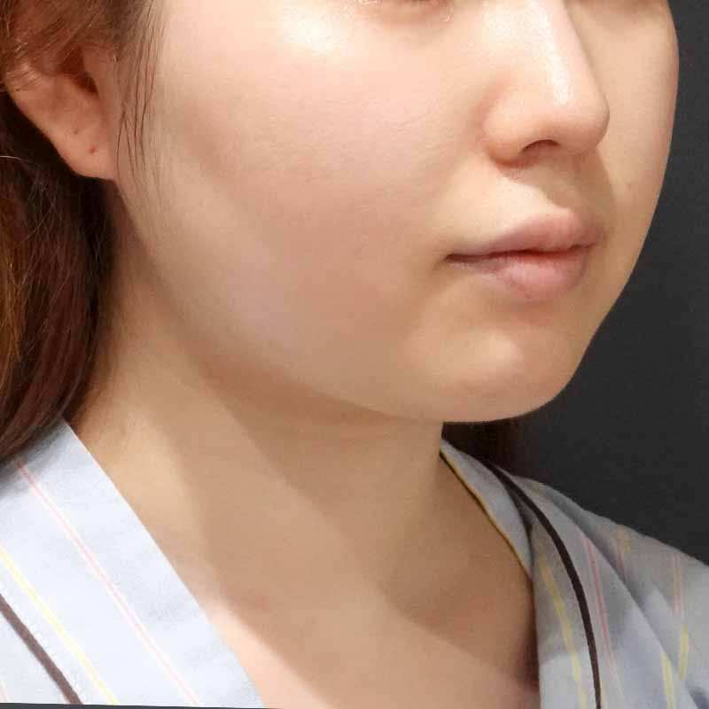 20240509_G27976_suzuki_face-liposuction_philtrum-botox追加写真①Before