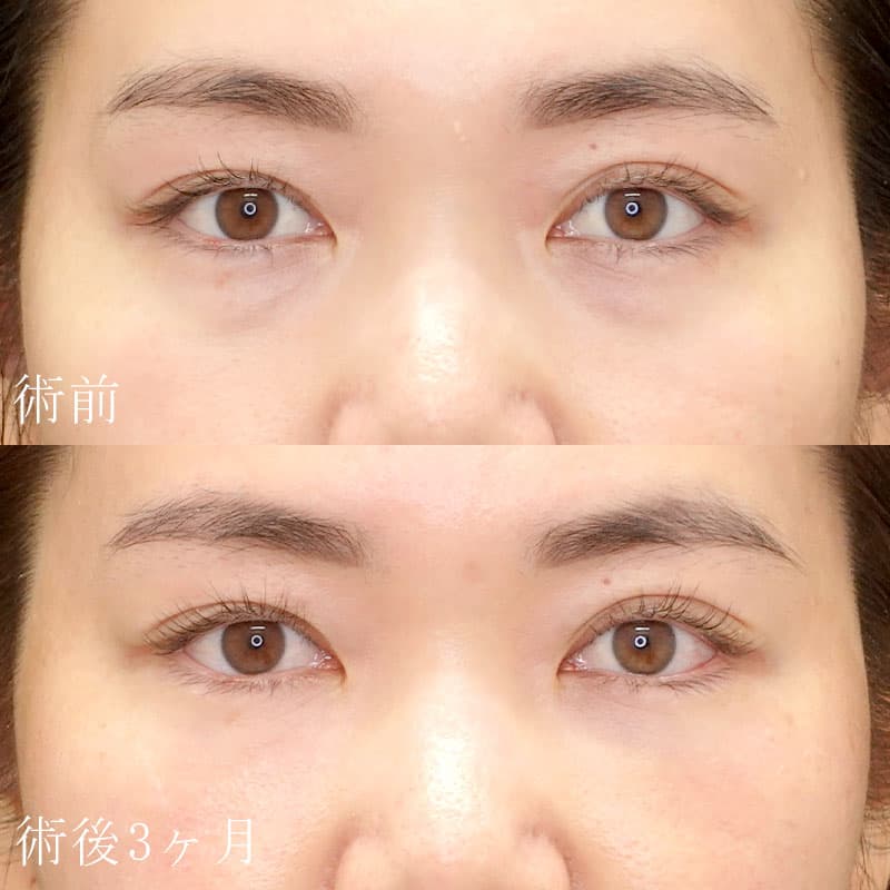 金子医師の裏ハムラ法の症例写真①