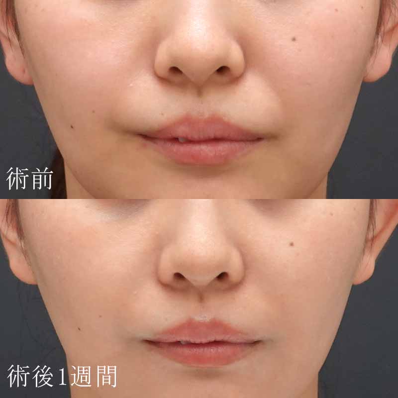 20241016_St202410162_tanaka_hyaluronic nasolabial foldsメイン横