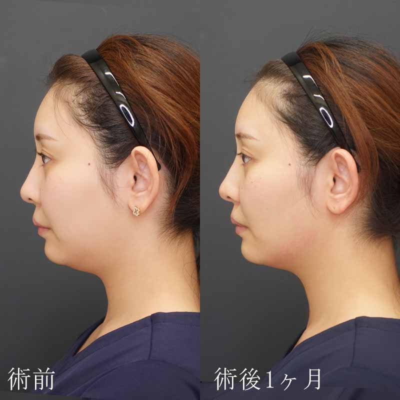 20241108_St20241108-2_volnewmerメイン縦