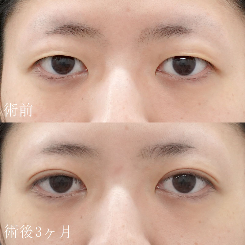 20241123_F2358_kaneko_double-incision-methodメイン横