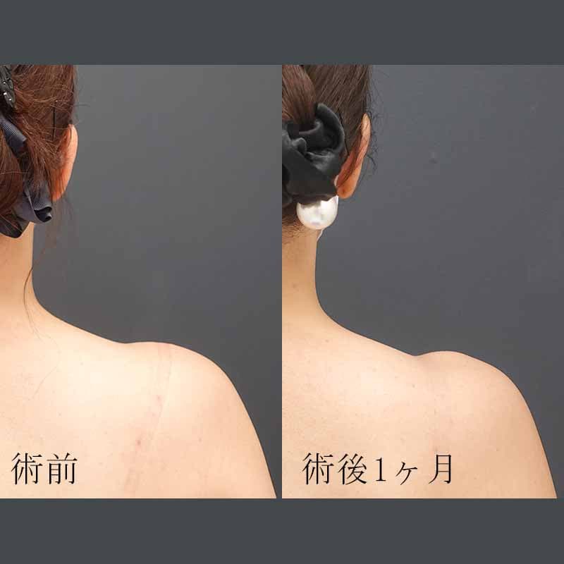 20241216_St20241216_matori_shoulder_botox01 縦