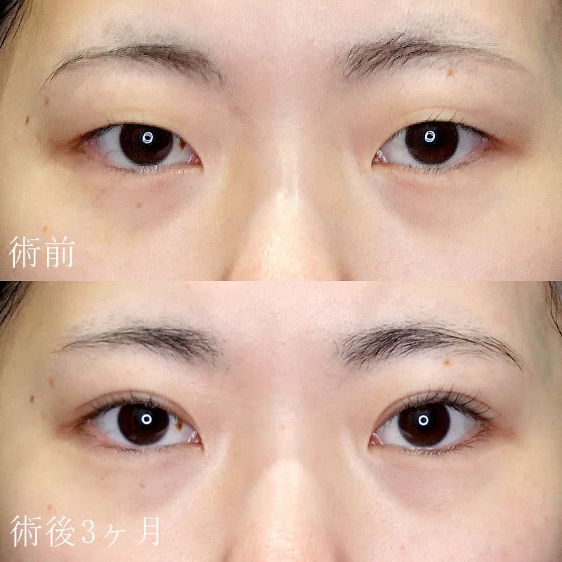 二重切開法の症例写真②