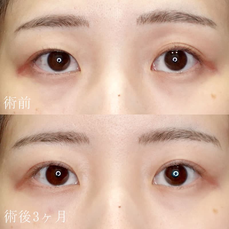 二重切開法の症例写真①