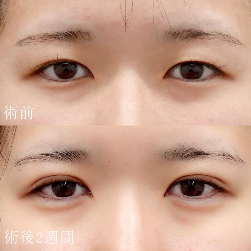 二重埋没法と涙袋のヒアルロン酸の症例写真③